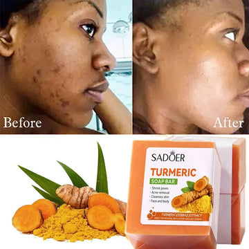 RadiantGlow Kojic Acid Soap with Turmeric for dark spots and skin brightening.